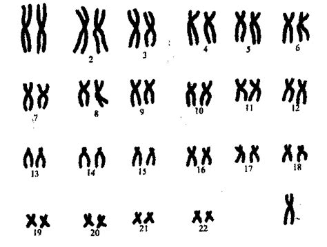 two y chromosomes 47 xyy syndrome medlineplus genetics