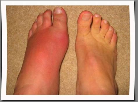 Causes Of Unexplained Swelling Of Left Foot And Ankle