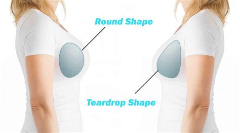 Teardrop Breast Augmentation
