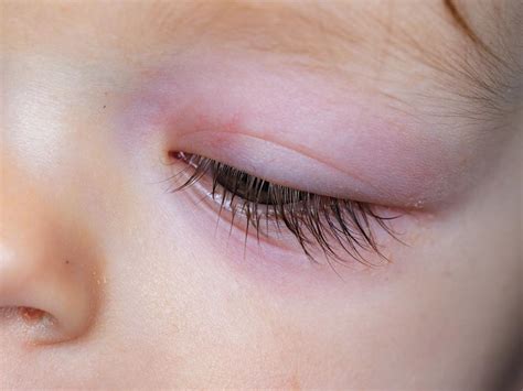 celulitis orbitaria causas síntomas y tratamiento Área oftalmológica