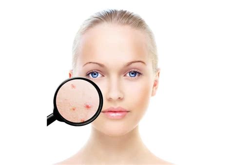 acne treatment facials peels  harborne birmingham