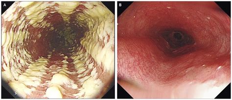 Candida Esophagitis Nejm