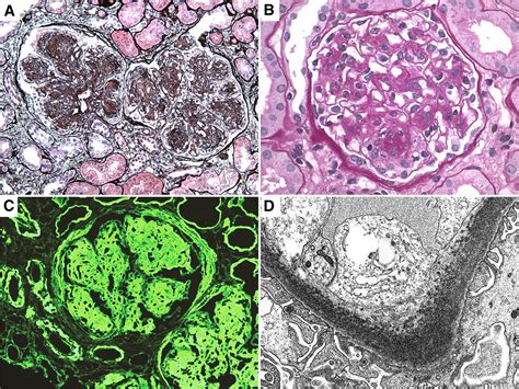 paraproteinrelated kidney disease glomerular diseases