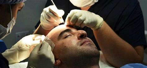Top Class Treatment Makes Turkey Hair Transplant Hotspot Anews