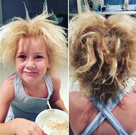 uncombable hair syndrome      exists  sounds