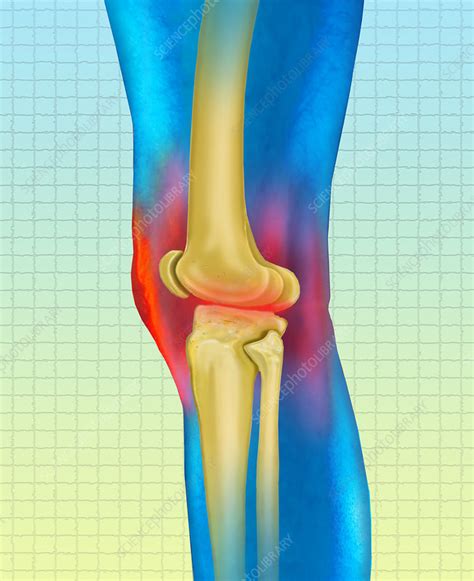 knee arthritis stock image  science photo library