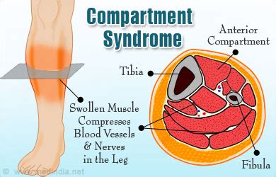 compartment syndrome types  symptoms diagnosis treatment