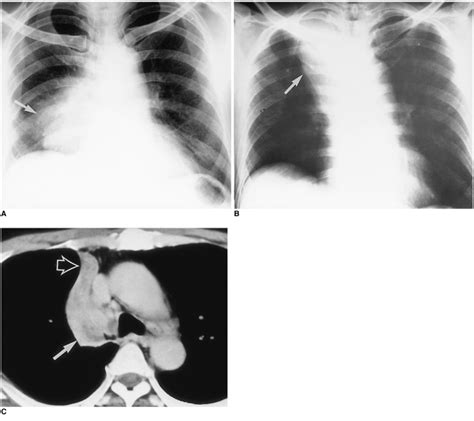 Migrating Right Upper Lobar Atelectasis Caused By Central Lung Cancer