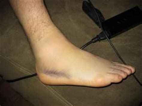 torn ligaments  ankle swelling  bruising pictures    heal