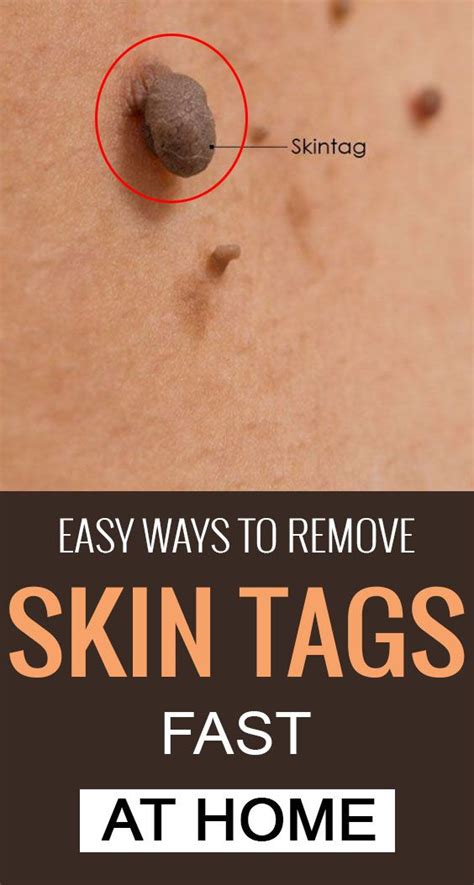 top 10 home remedies to remove skin tags naturally skin tag removal