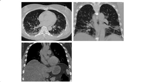 Male Patient 64 Years Ct Chest Shows Bilateral Lower Lobar Subpleural