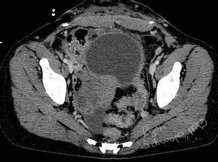 roentgen ray reader false perpetuations ovarian torsion doppler ultrasound  ct
