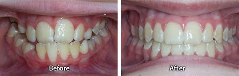 common orthodontic issues wade williams orthodontics  woodlands tx