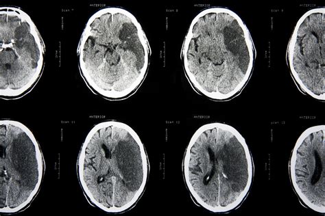 traumatic brain injury  raise stroke risk huffpost