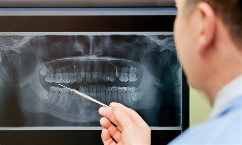 Surgical Removal Of Wisdom Teeth Pinole Oral Surgery