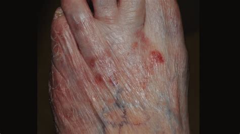84 Year Old Female With Rash On Left Foot The Doctor S