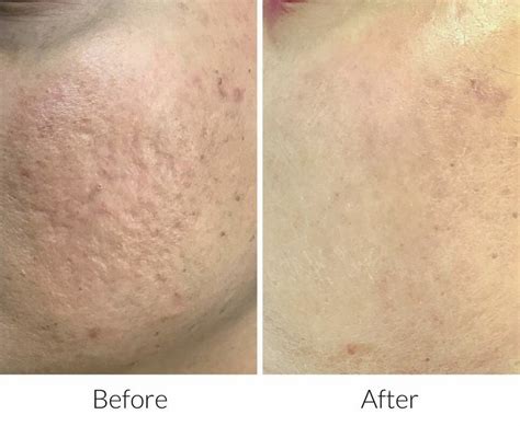 subcision  acne scar revision  manchester nh
