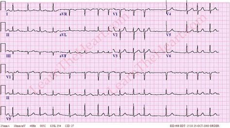 Atrial Fibrillation With Normal Ventricular Rate Example 1