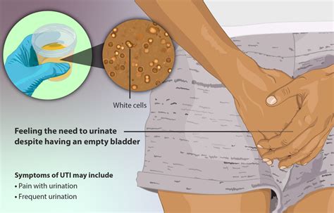 urinary tract infection condition ck ng urology minimally invasive surgery