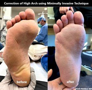 high arch  causing  foot problems    solution cnos