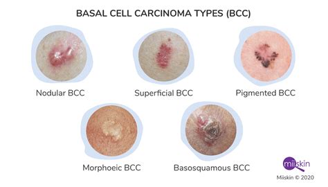 basal cell carcinoma symptoms types  pictures