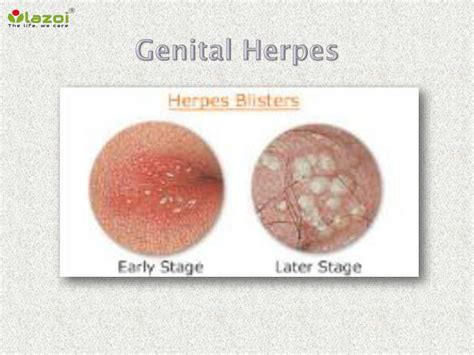 ppt genital herpes symptoms causes diagnosis and