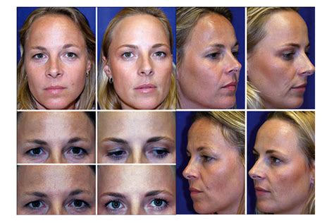 study proves botox freezes  aging process national laser