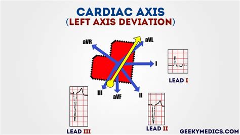 cardiac axis ecg interpretation geeky medics