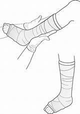 Leg Cast Drawing Clipart Broken Plaster Examination Vector Injury Getdrawings Illustration Paintingvalley Webstockreview Foot Vectors sketch template