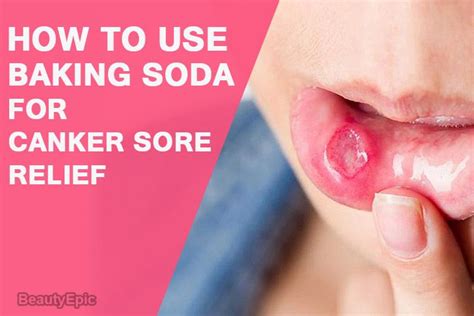 how can baking soda help relieve canker sores canker sore cankers