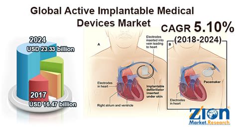 global active implantable medical devices market worth usd