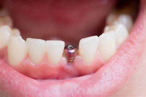 dental implant surgery recovery minerva
