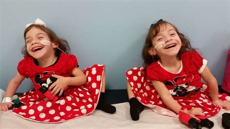 What Life Is Like Now For Formerly Conjoined Twin Sisters