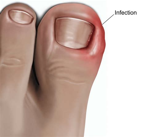 ingrown toenails  symptoms  treatment