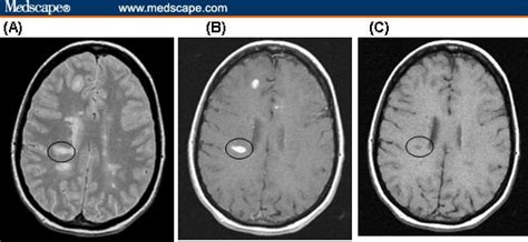 The Role Of Mri In Multiple Sclerosis Diagnosis And Management
