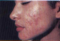 pimples care treatment  pimples