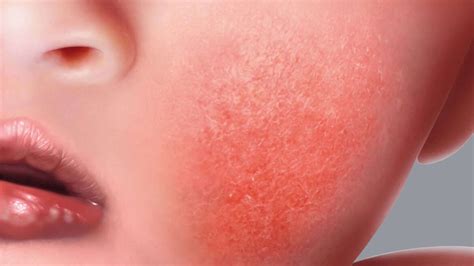 Eczema Can Be Treated Epa Skinclinic