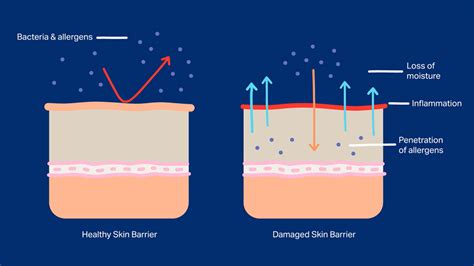 skin barrier basics  people  eczema national eczema association