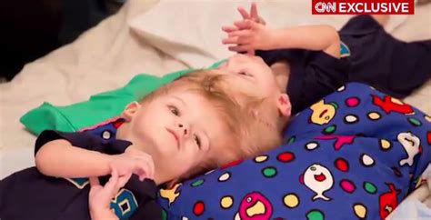 Twins Conjoined At Head Successfully Separated After 27 Hour Operation