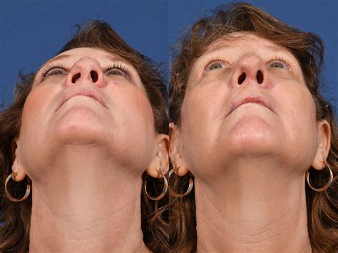 revision rhinoplasty before and after 2