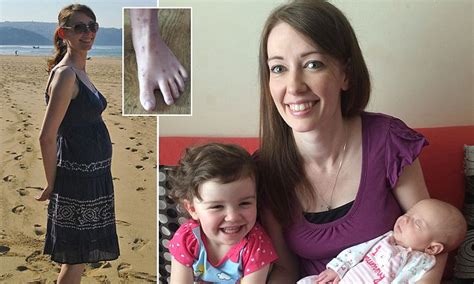 the mother of two who s severely allergic to being pregnant daily mail online