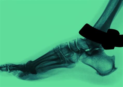 Why Ankle Monitors Aren’t Humane And Are Another Kind Of