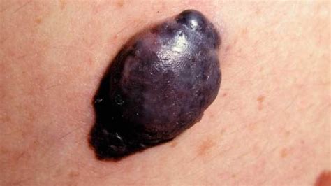 nodular melanoma symptoms risk factors diagnosis  treatment