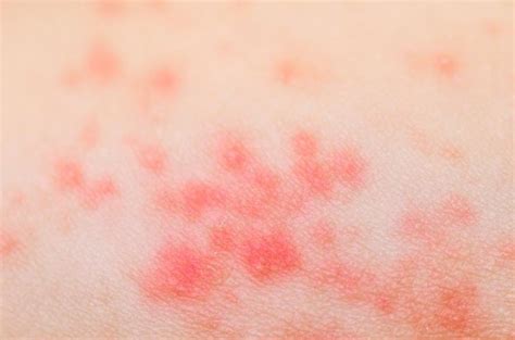 5 Things You Need To Know About Heat Rash Livestrong