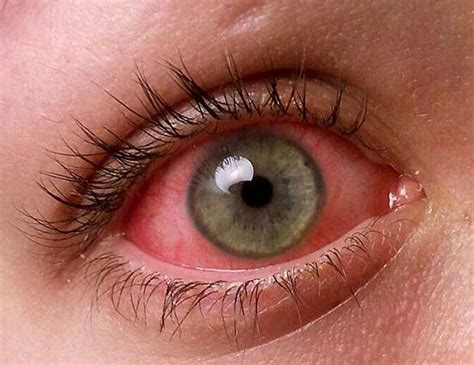 pink eye conjunctivitis symptoms treatments  prevention