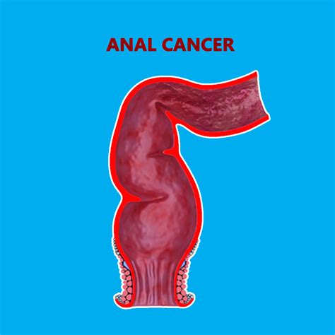 best cancer hospital in india anal cancer treatment in coimbatore
