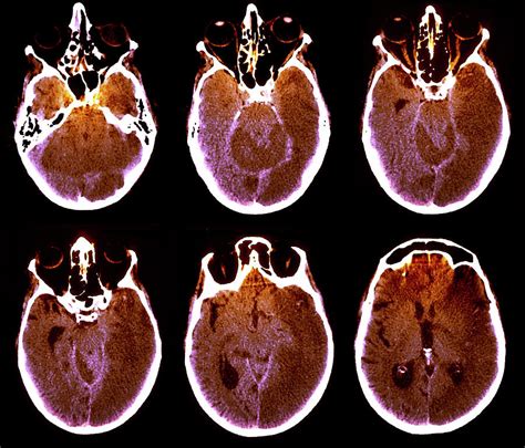 brain  alzheimers disease photograph  zephyrscience photo