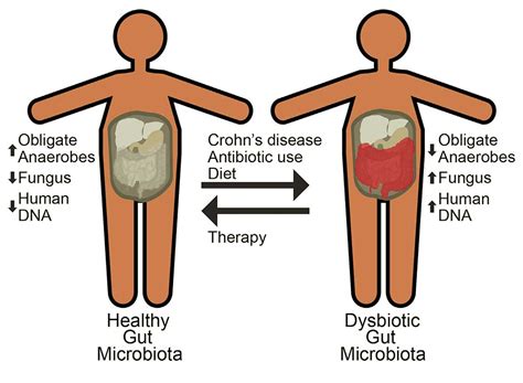 crohns disease treatments dont fully restore healthy gut microbes