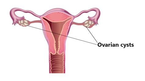 ovarian cyst causes symptoms risk factors and treatment