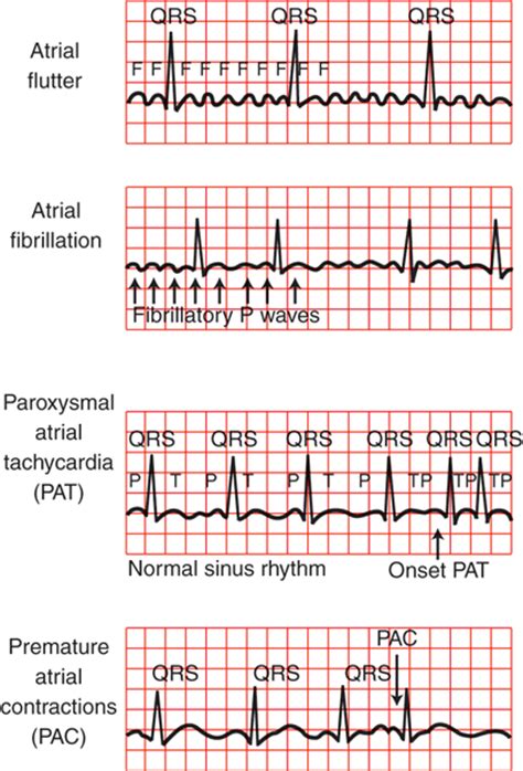Atrial Fibrillation And Atrial Flutter Diseases And Conditions